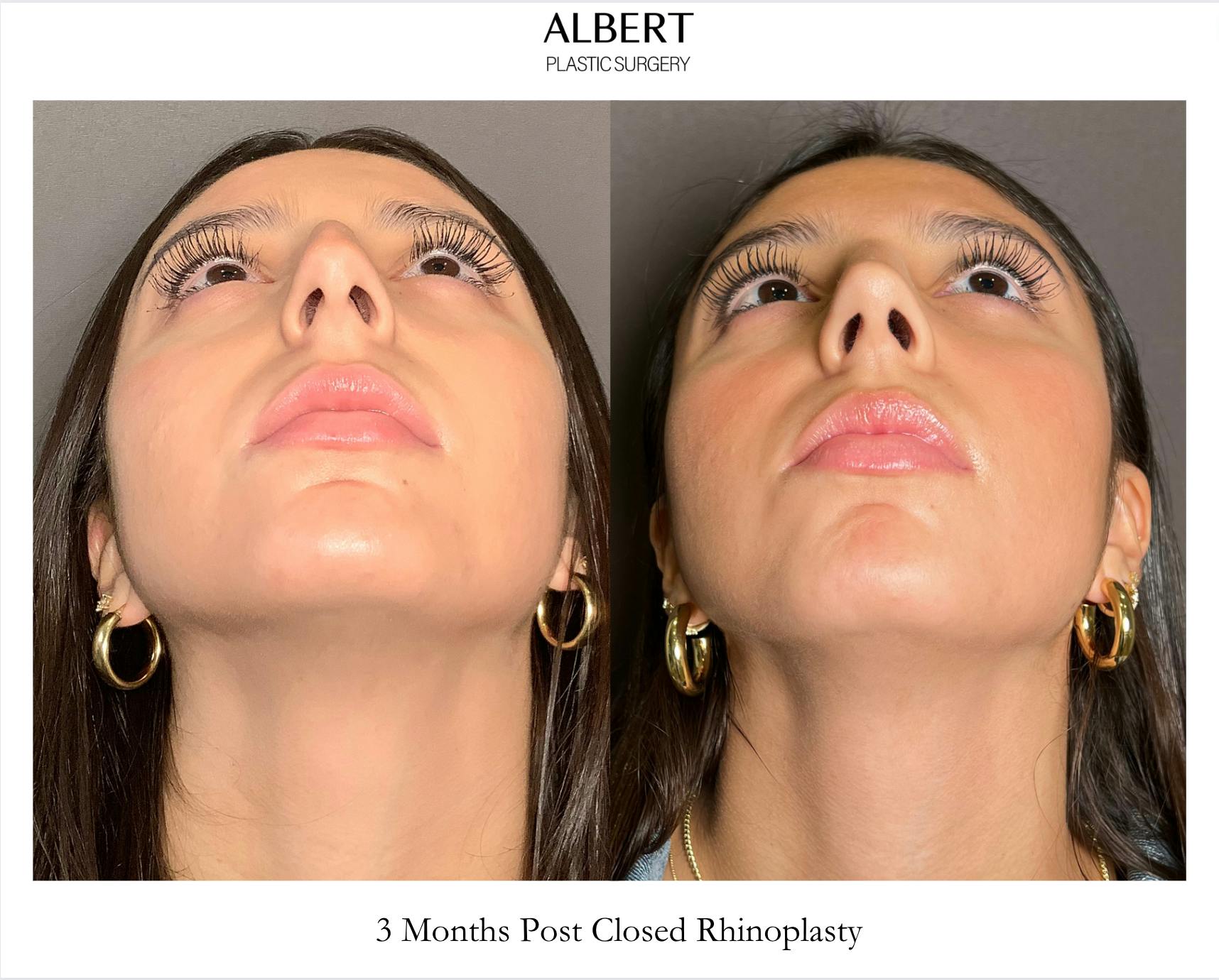 Rhinoplasty Before & After Gallery - Patient 393874 - Image 6