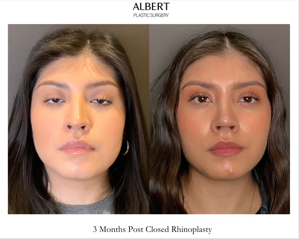 Rhinoplasty Before & After Gallery - Patient 127898 - Image 3