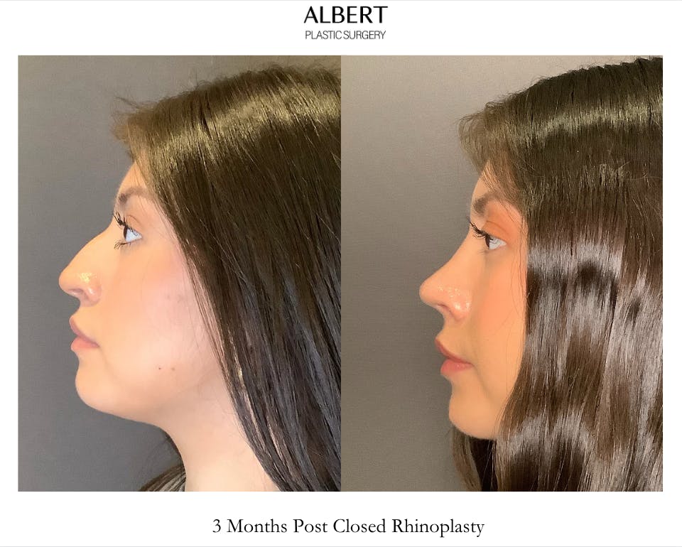 Rhinoplasty Before & After Gallery - Patient 127898 - Image 4