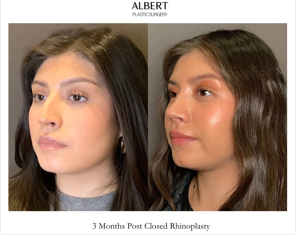 Rhinoplasty Before & After Gallery - Patient 127898 - Image 5