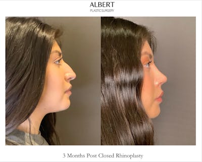 Rhinoplasty Before & After Gallery - Patient 127898 - Image 1