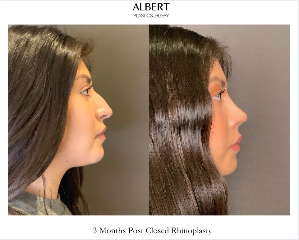 Rhinoplasty Before & After Gallery - Patient 127898 - Image 1