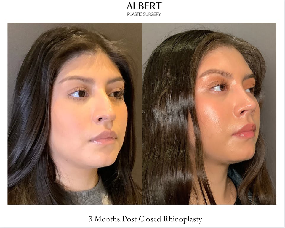 Rhinoplasty Before & After Gallery - Patient 127898 - Image 2