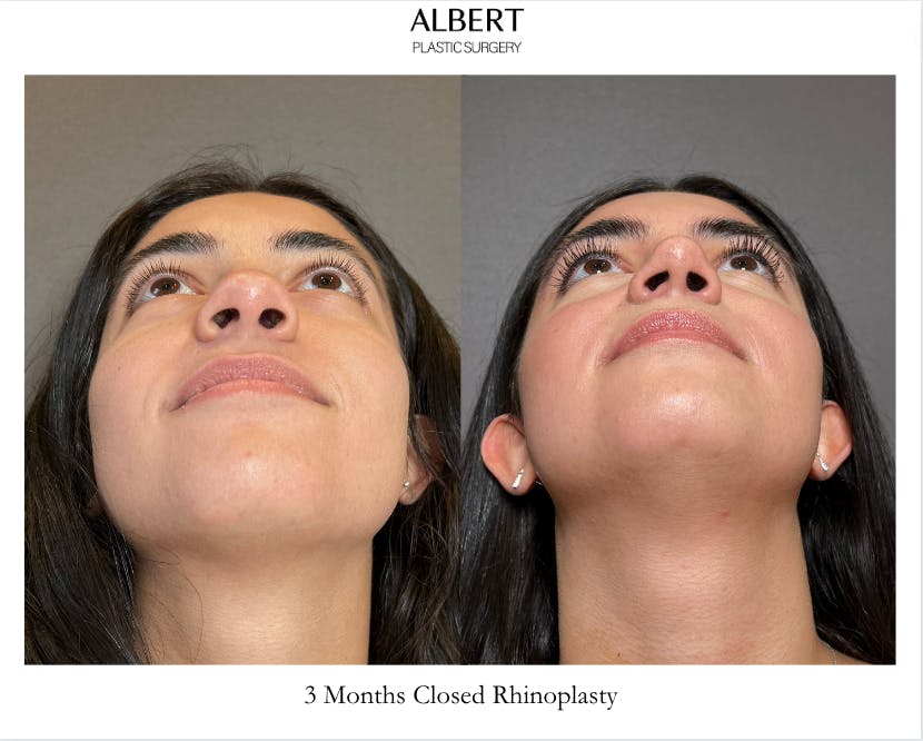 Rhinoplasty Before & After Gallery - Patient 171247 - Image 4