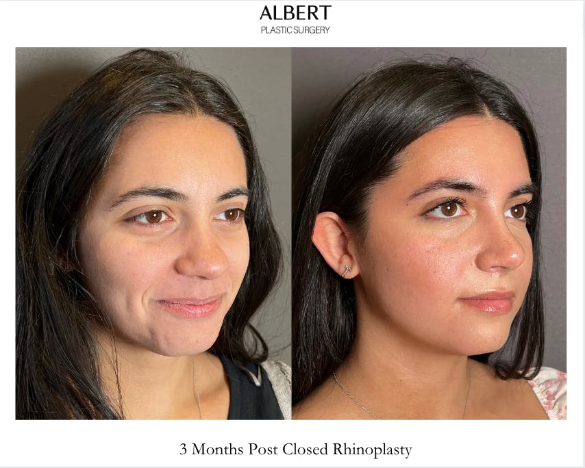 Rhinoplasty Before & After Gallery - Patient 171247 - Image 2