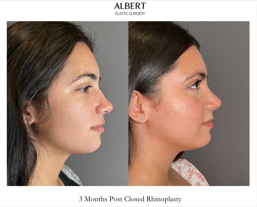 Rhinoplasty Before & After Gallery - Patient 171247 - Image 1