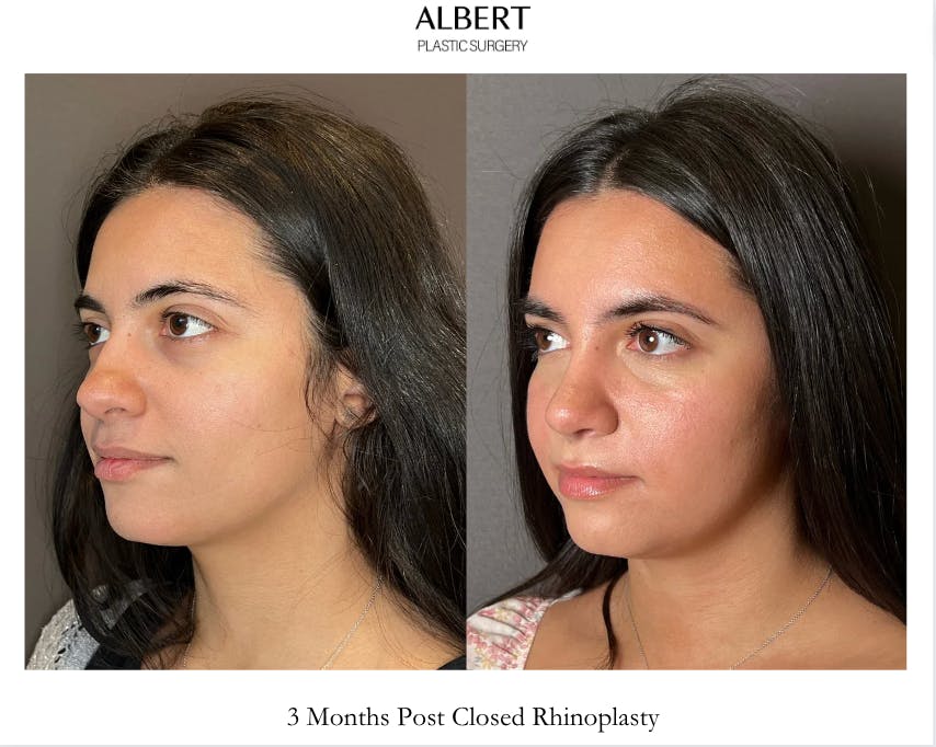 Rhinoplasty Before & After Gallery - Patient 171247 - Image 5