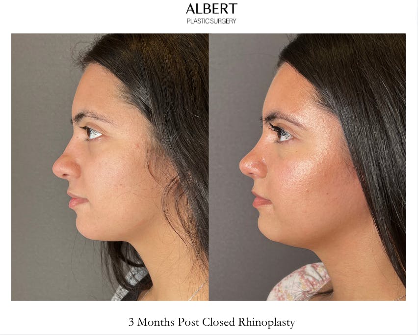 Rhinoplasty Before & After Gallery - Patient 171247 - Image 6