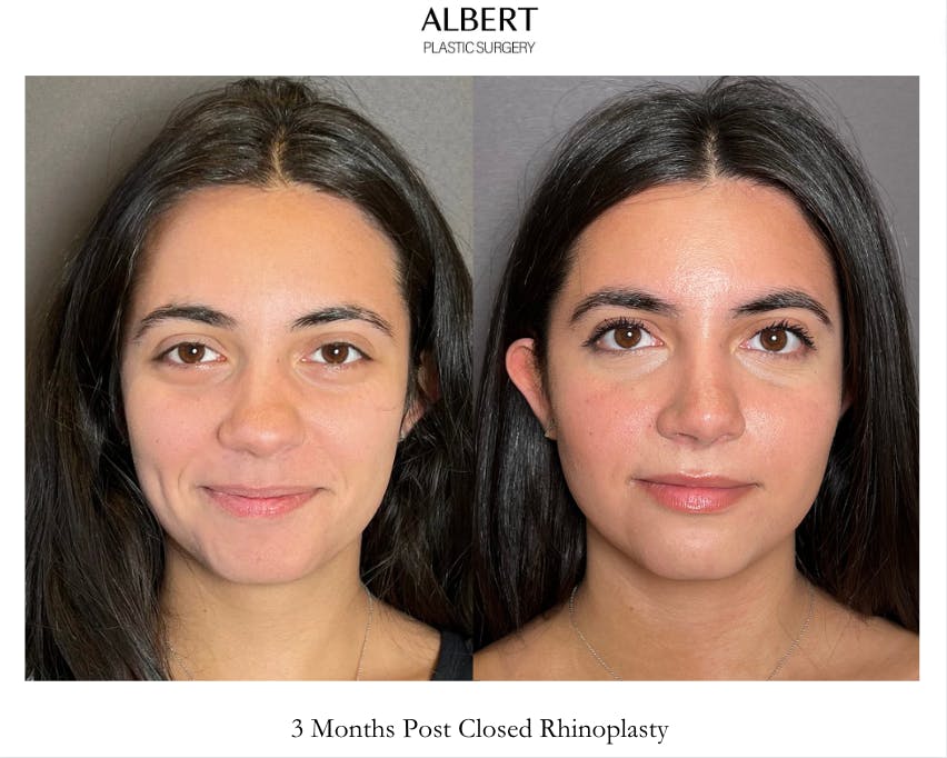 Rhinoplasty Before & After Gallery - Patient 171247 - Image 3