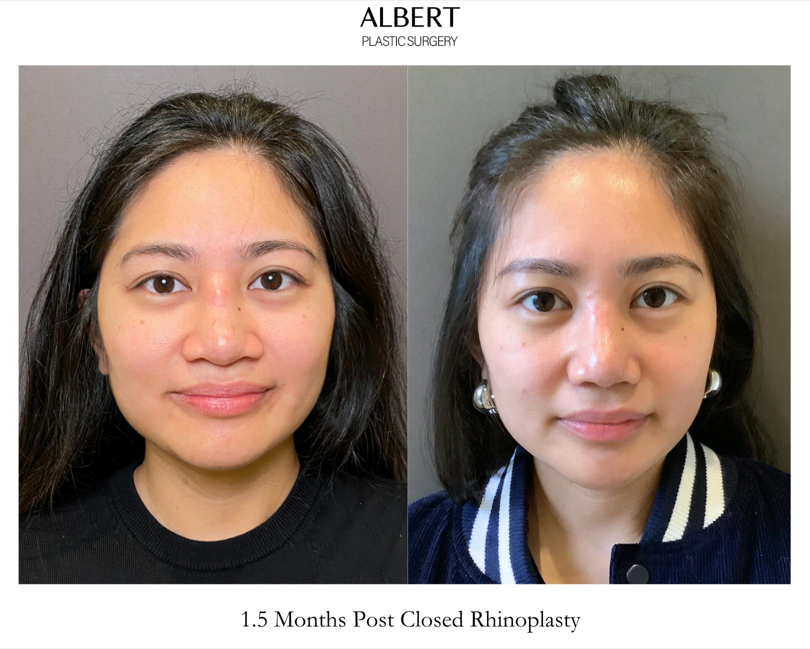 Revision Rhinoplasty Before & After Gallery - Patient 460622 - Image 2