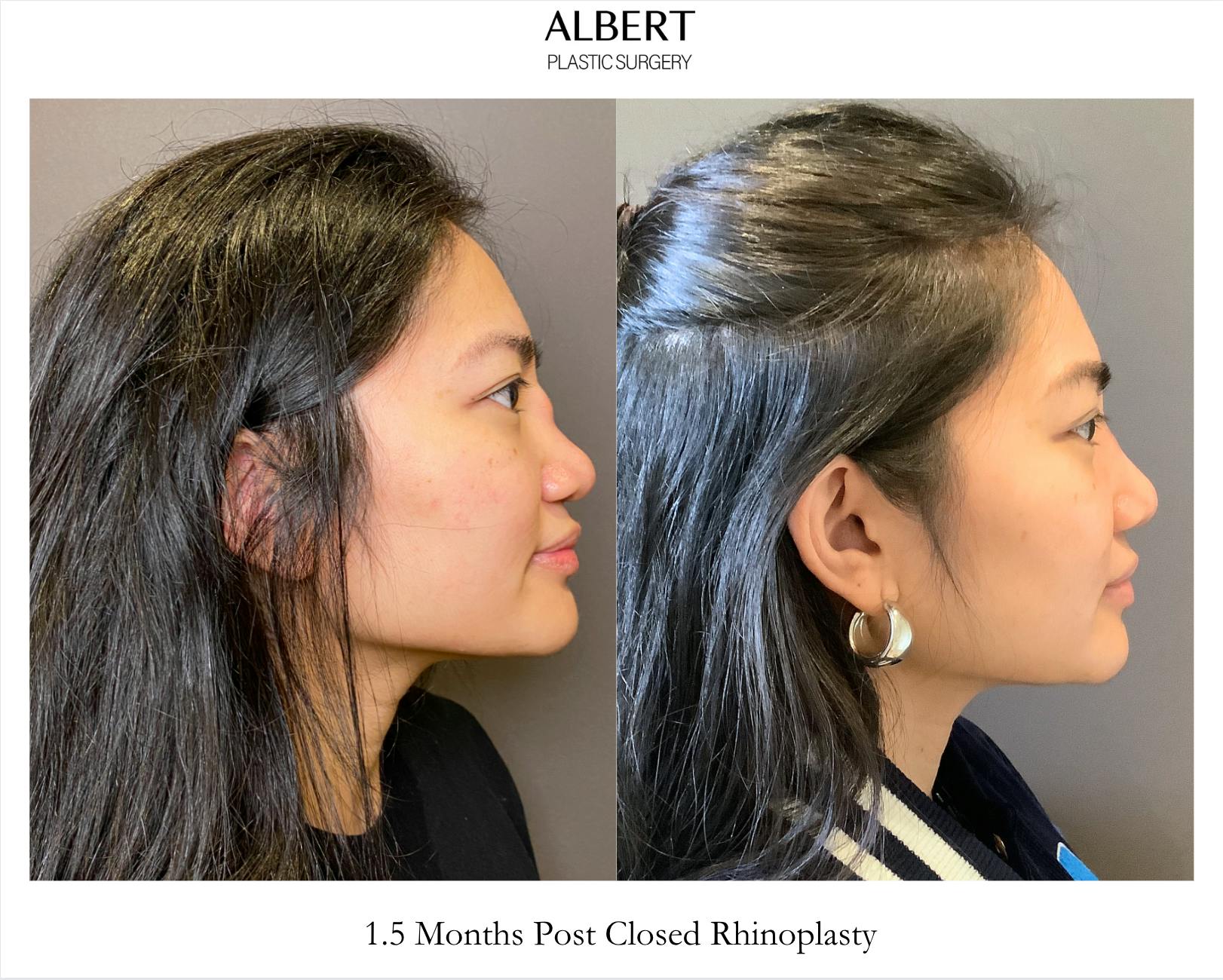 Revision Rhinoplasty Before & After Gallery - Patient 460622 - Image 1