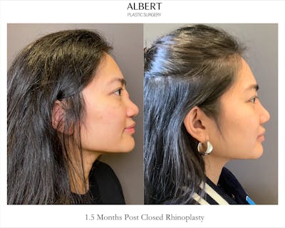 Revision Rhinoplasty Before & After Gallery - Patient 460622 - Image 1
