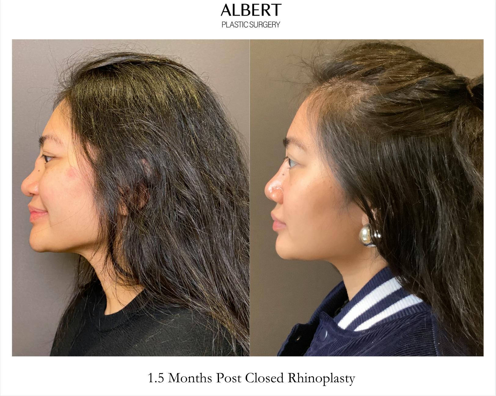 Revision Rhinoplasty Before & After Gallery - Patient 460622 - Image 3