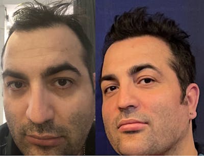 Hair Transplant Before & After Gallery - Patient 303317 - Image 1