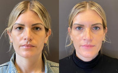 Eyelid Surgery Before & After Gallery - Patient 235972 - Image 1