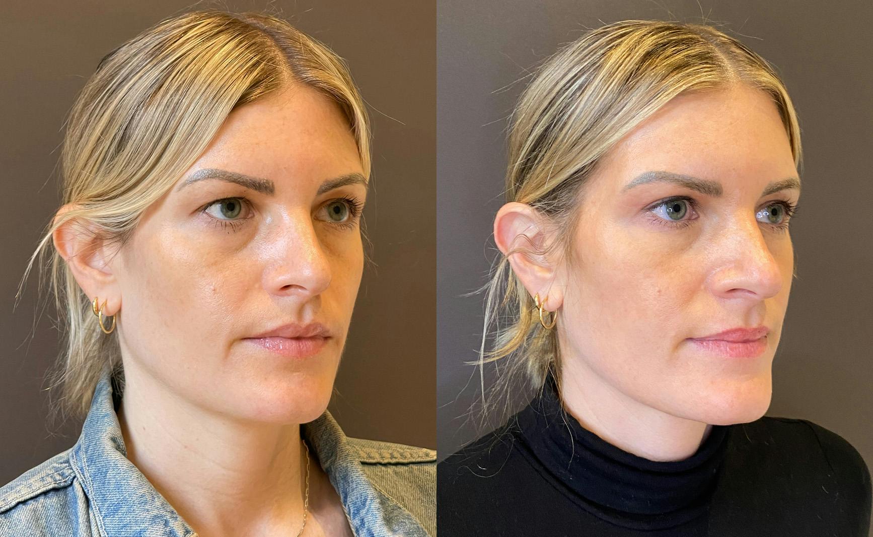 Eyelid Surgery Before & After Gallery - Patient 235972 - Image 2