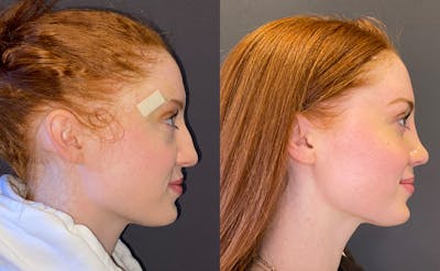 Rhinoplasty Before & After Gallery - Patient 348332 - Image 1