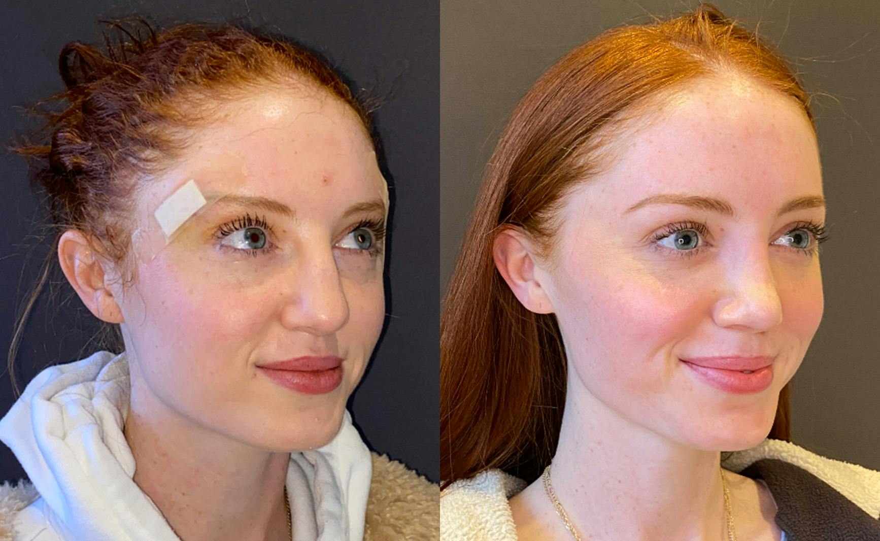 Rhinoplasty Before & After Gallery - Patient 348332 - Image 2