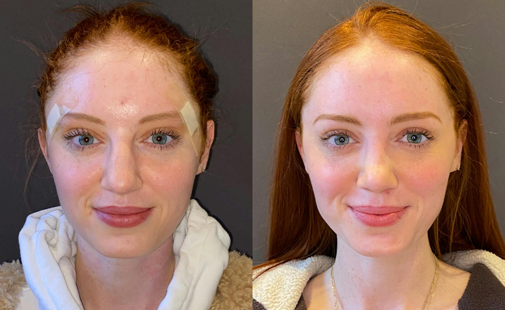 Rhinoplasty Before & After Gallery - Patient 348332 - Image 3