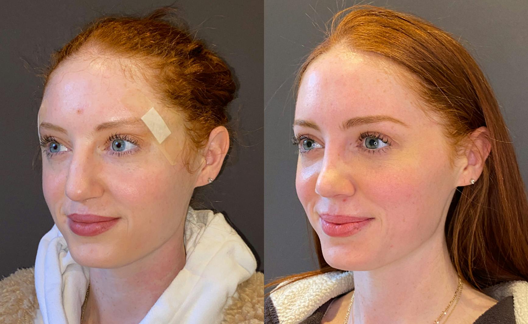 Rhinoplasty Before & After Gallery - Patient 348332 - Image 4