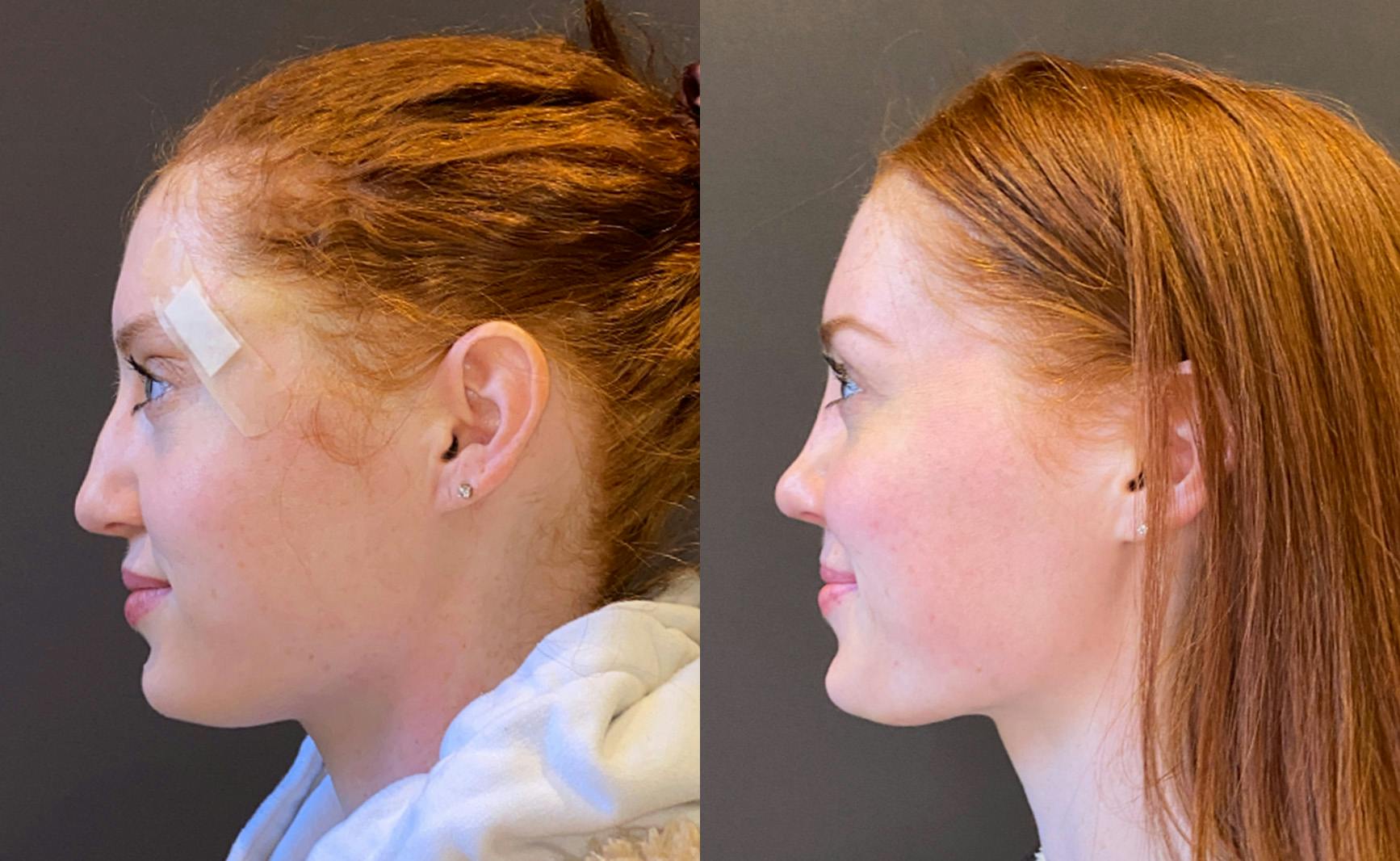 Rhinoplasty Before & After Gallery - Patient 348332 - Image 5