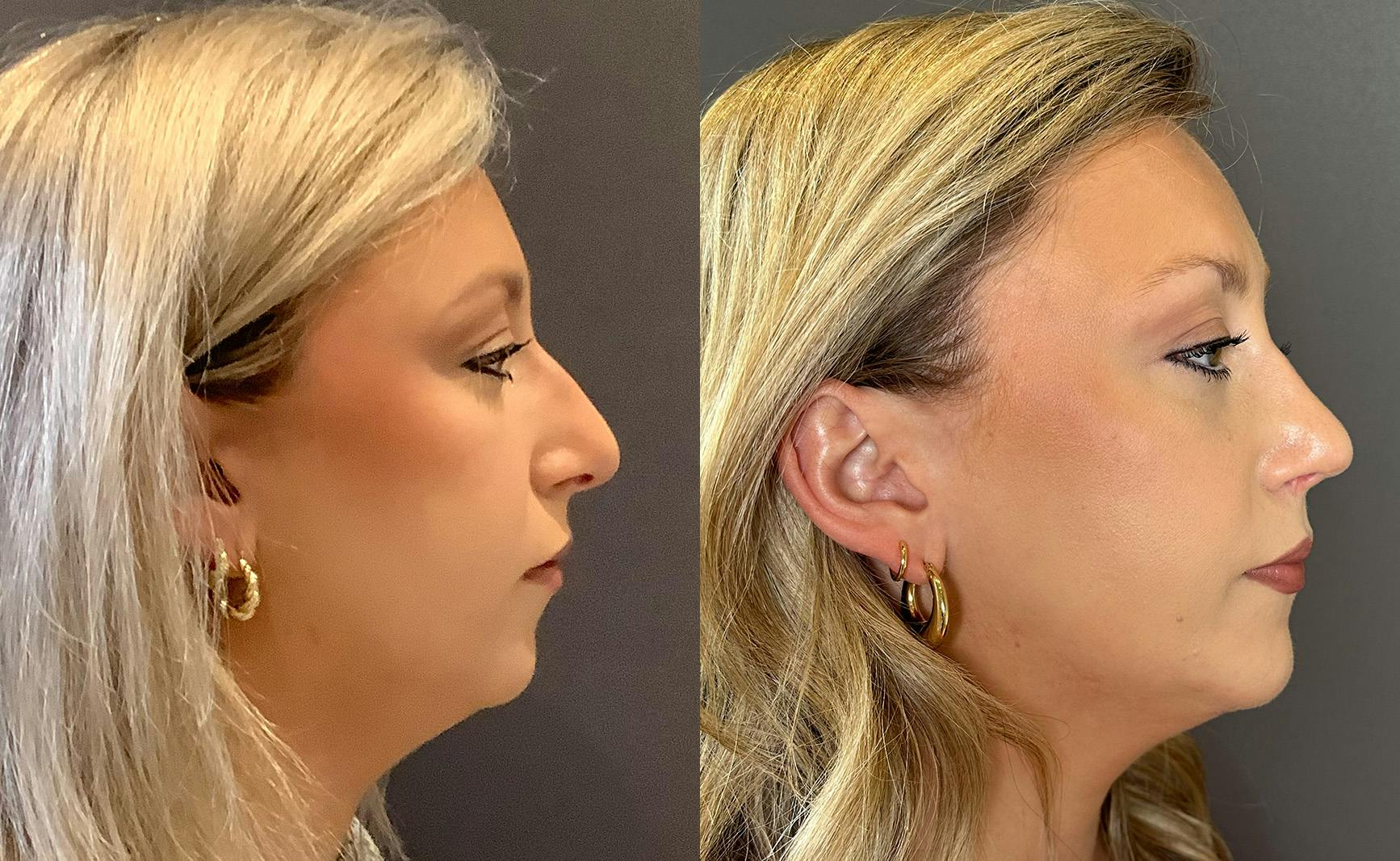 Rhinoplasty Before & After Gallery - Patient 124652 - Image 1
