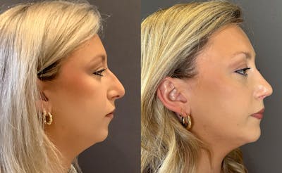 Chin Augmentation Before & After Gallery - Patient 179444 - Image 1