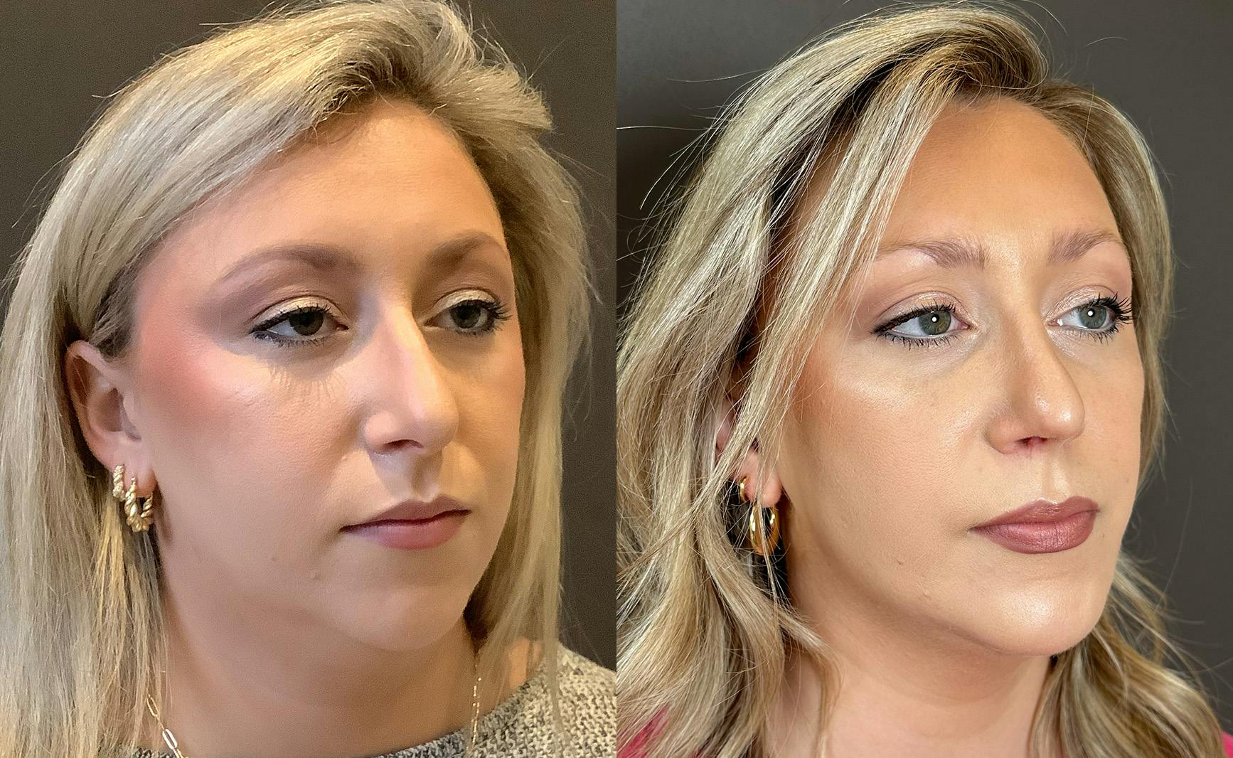 Rhinoplasty Before & After Gallery - Patient 309005 - Image 2