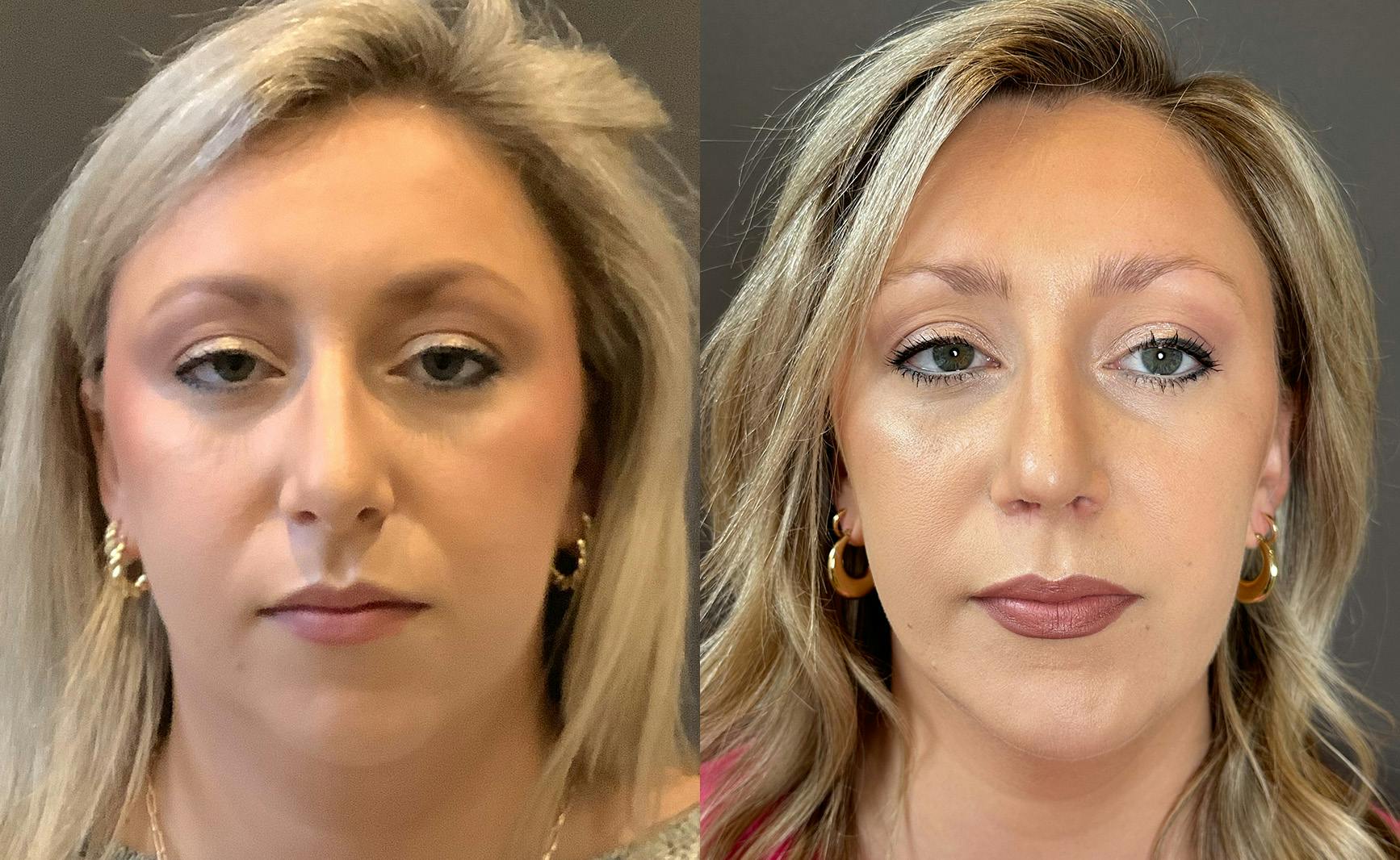 Rhinoplasty Before & After Gallery - Patient 309005 - Image 3