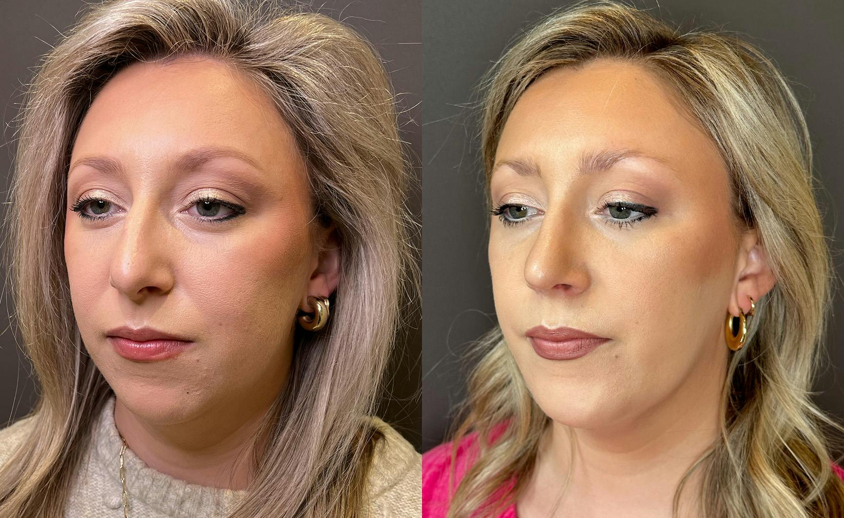 Rhinoplasty Before & After Gallery - Patient 124652 - Image 4