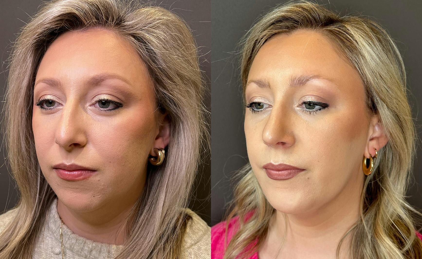Rhinoplasty Before & After Gallery - Patient 309005 - Image 4
