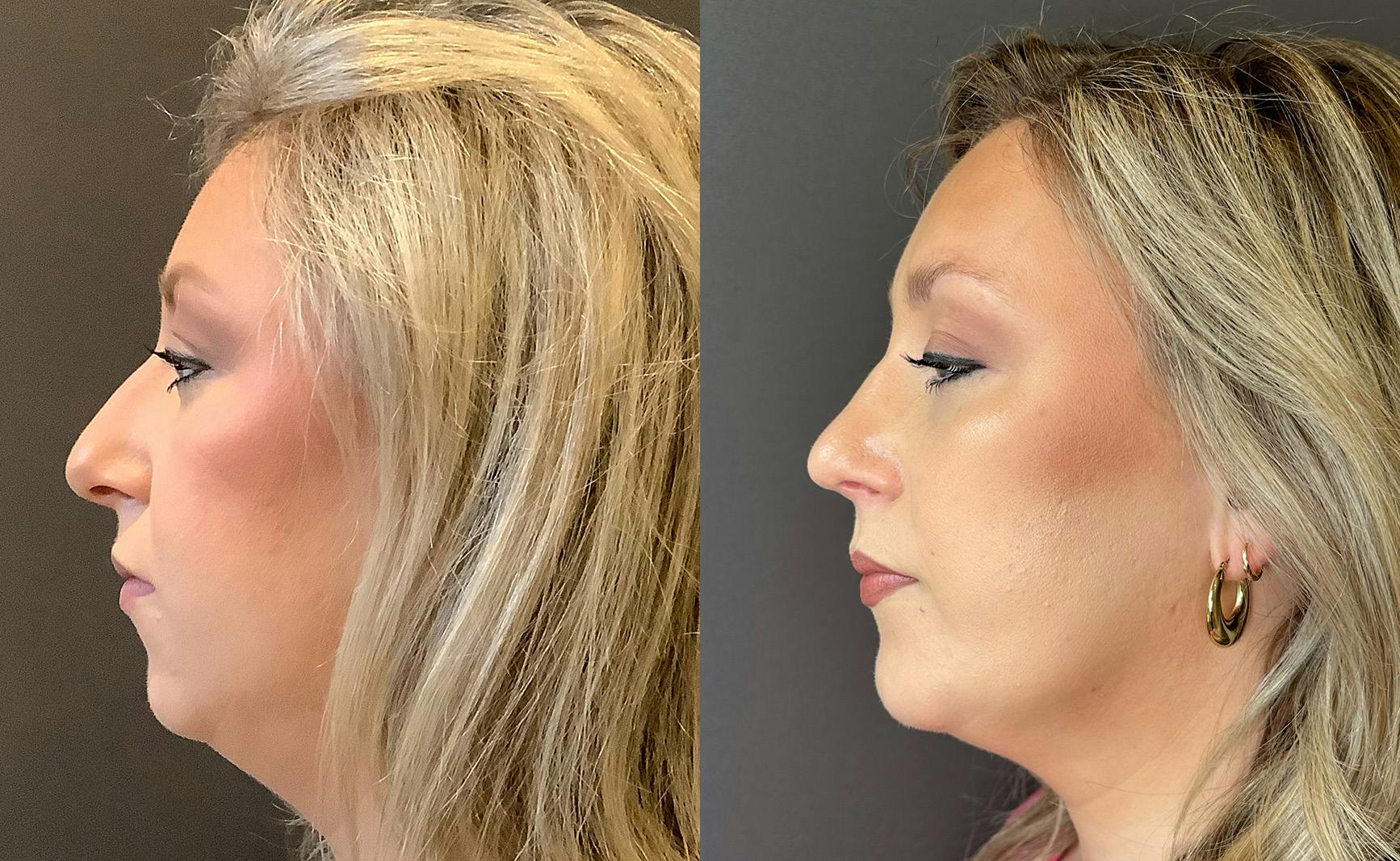Rhinoplasty Before & After Gallery - Patient 309005 - Image 5