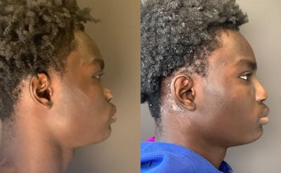 Rhinoplasty Before & After Gallery - Patient 788730 - Image 1