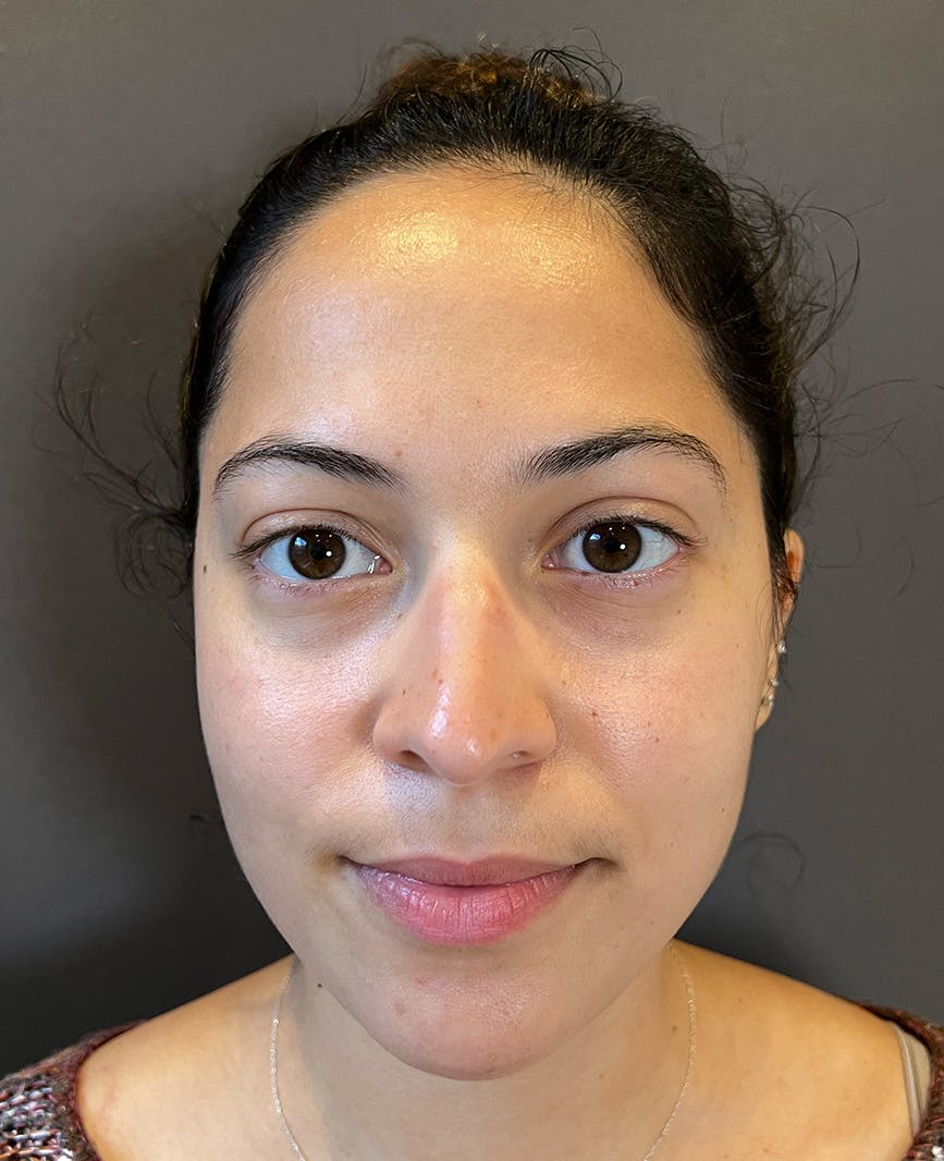 Rhinoplasty Before & After Gallery - Patient 366724 - Image 3