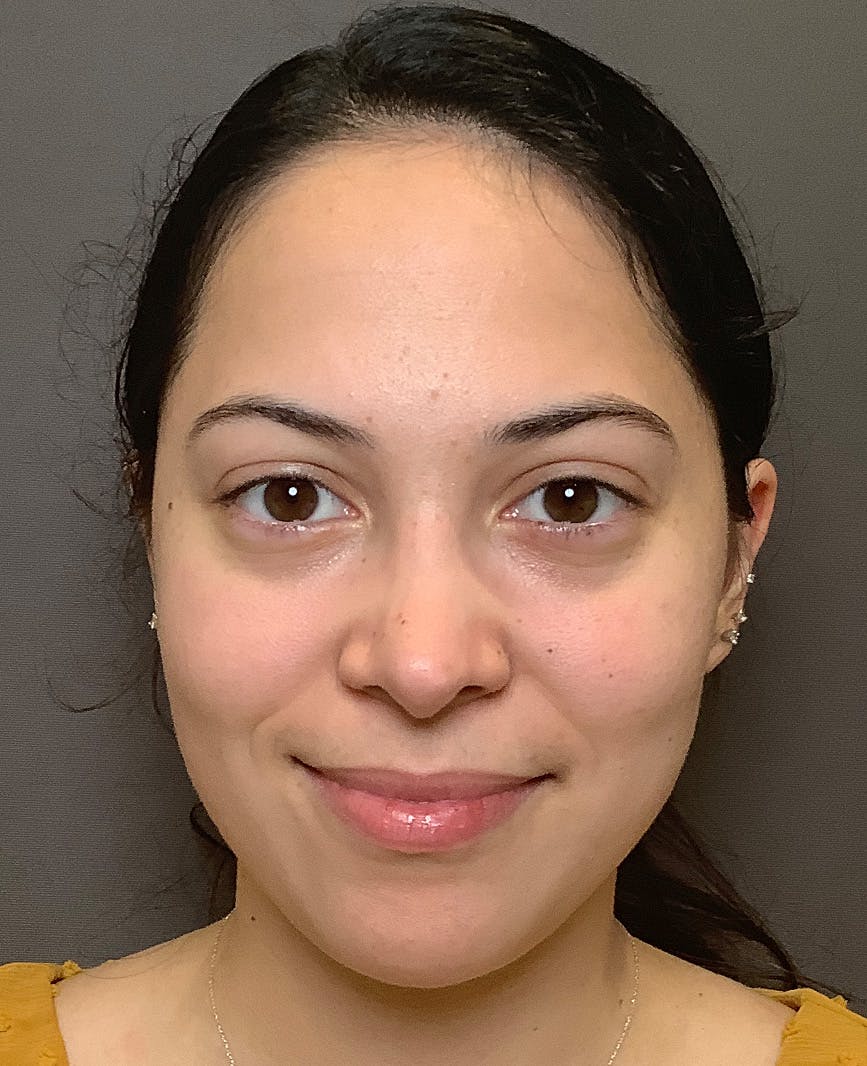 Rhinoplasty Before & After Gallery - Patient 366724 - Image 4