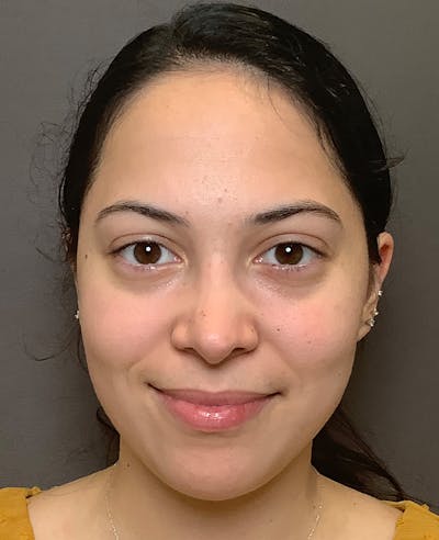 Rhinoplasty Before & After Gallery - Patient 366724 - Image 2