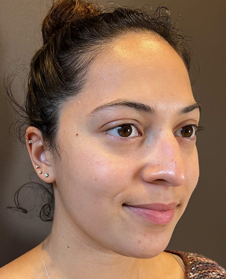 Rhinoplasty Before & After Gallery - Patient 366724 - Image 5