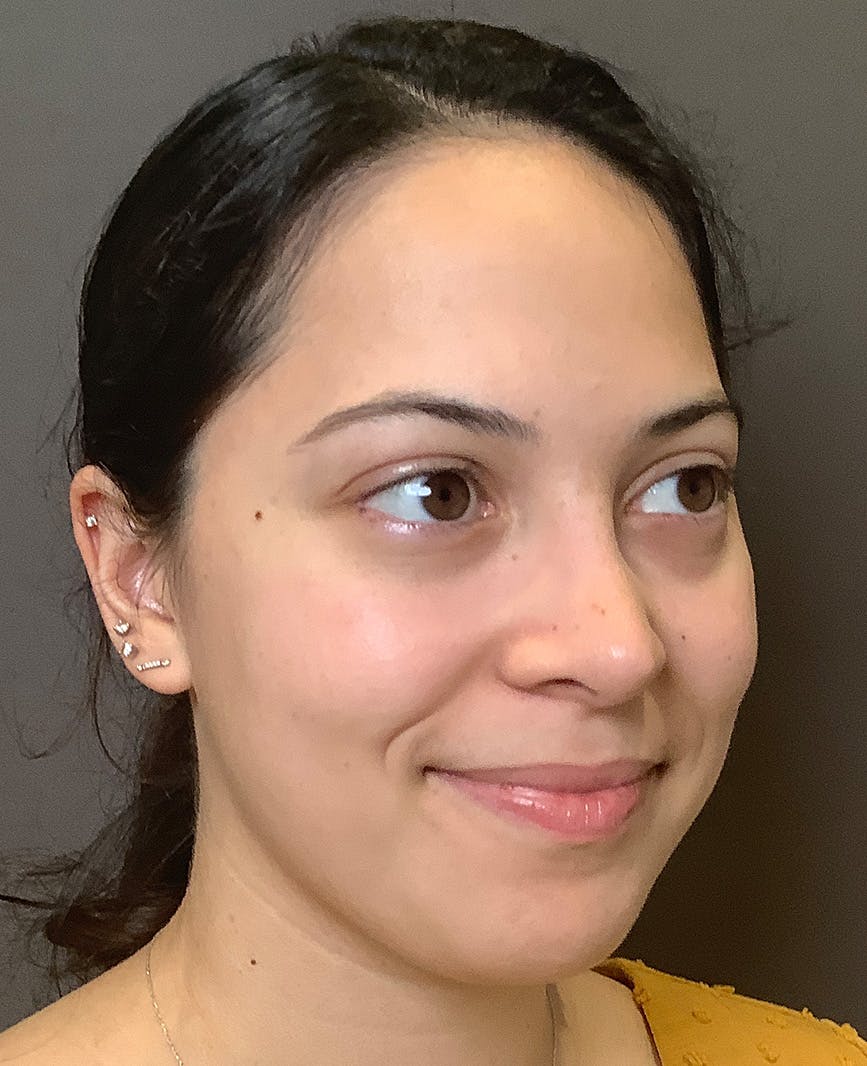 Rhinoplasty Before & After Gallery - Patient 366724 - Image 6
