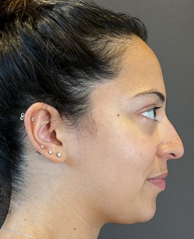 Rhinoplasty Before & After Gallery - Patient 366724 - Image 1