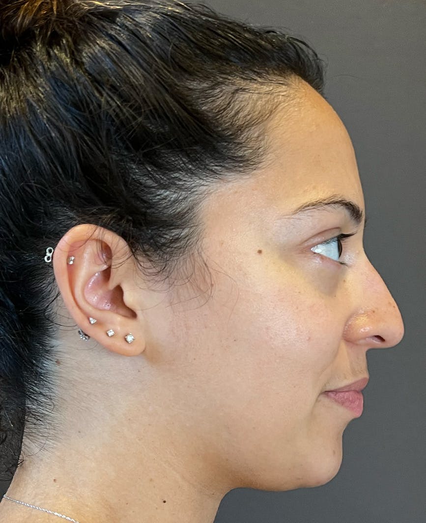 Rhinoplasty Before & After Gallery - Patient 366724 - Image 1
