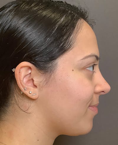 Rhinoplasty Before & After Gallery - Patient 366724 - Image 2