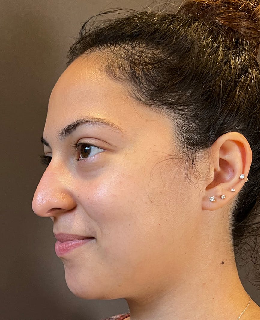 Rhinoplasty Before & After Gallery - Patient 366724 - Image 7