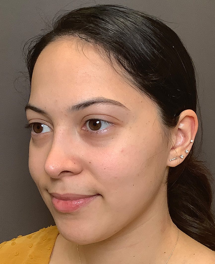 Rhinoplasty Before & After Gallery - Patient 366724 - Image 8