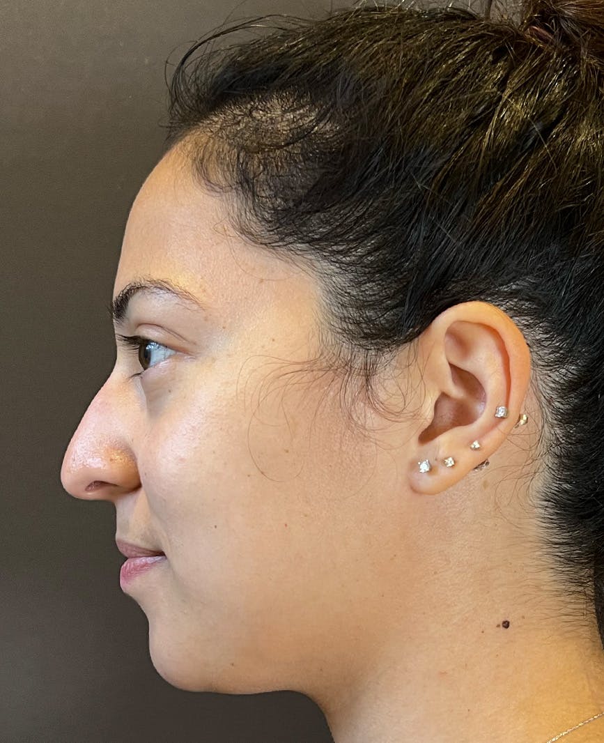 Rhinoplasty Before & After Gallery - Patient 366724 - Image 9