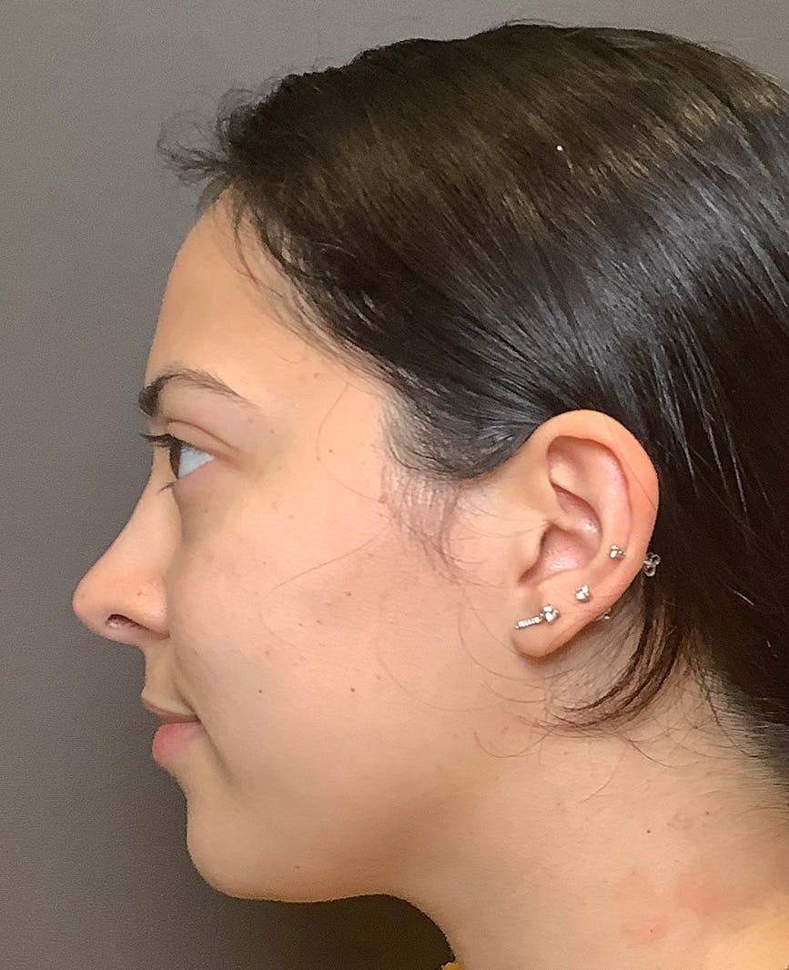 Rhinoplasty Before & After Gallery - Patient 366724 - Image 10