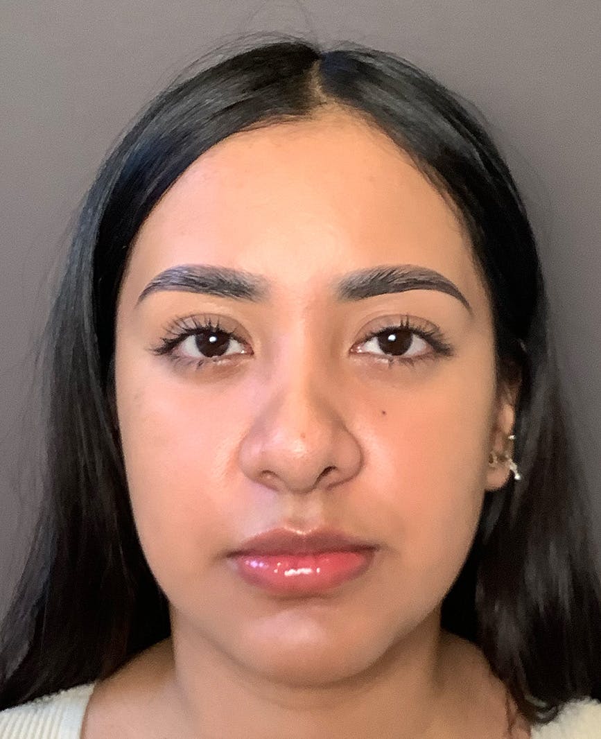 Revision Rhinoplasty Before & After Gallery - Patient 211946 - Image 3