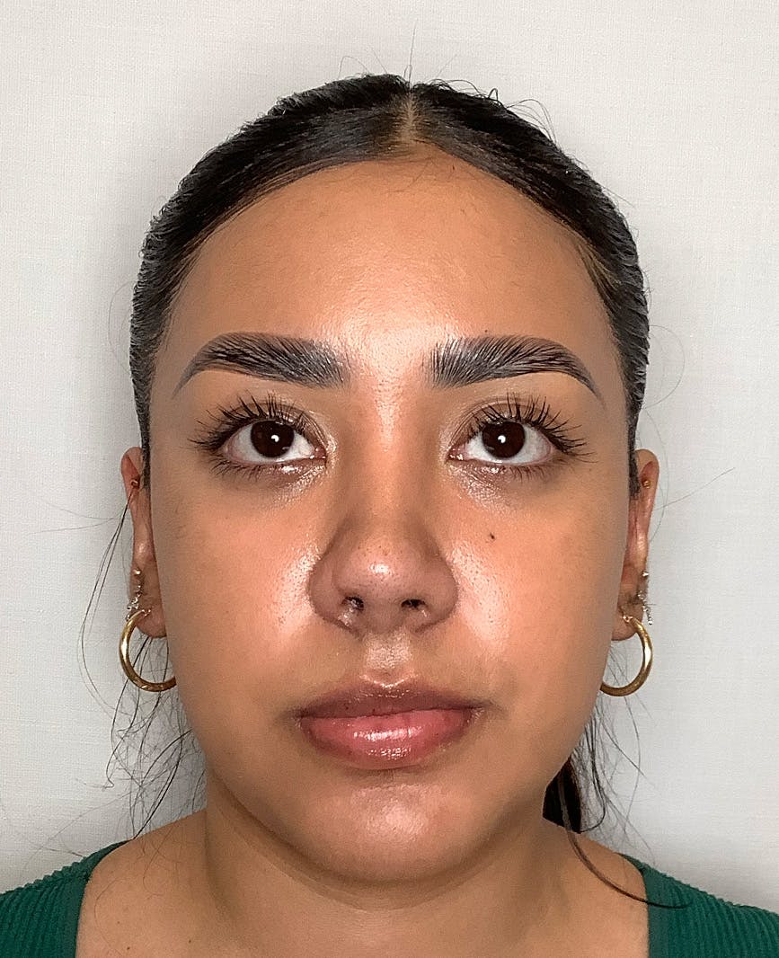 Revision Rhinoplasty Before & After Gallery - Patient 211946 - Image 4
