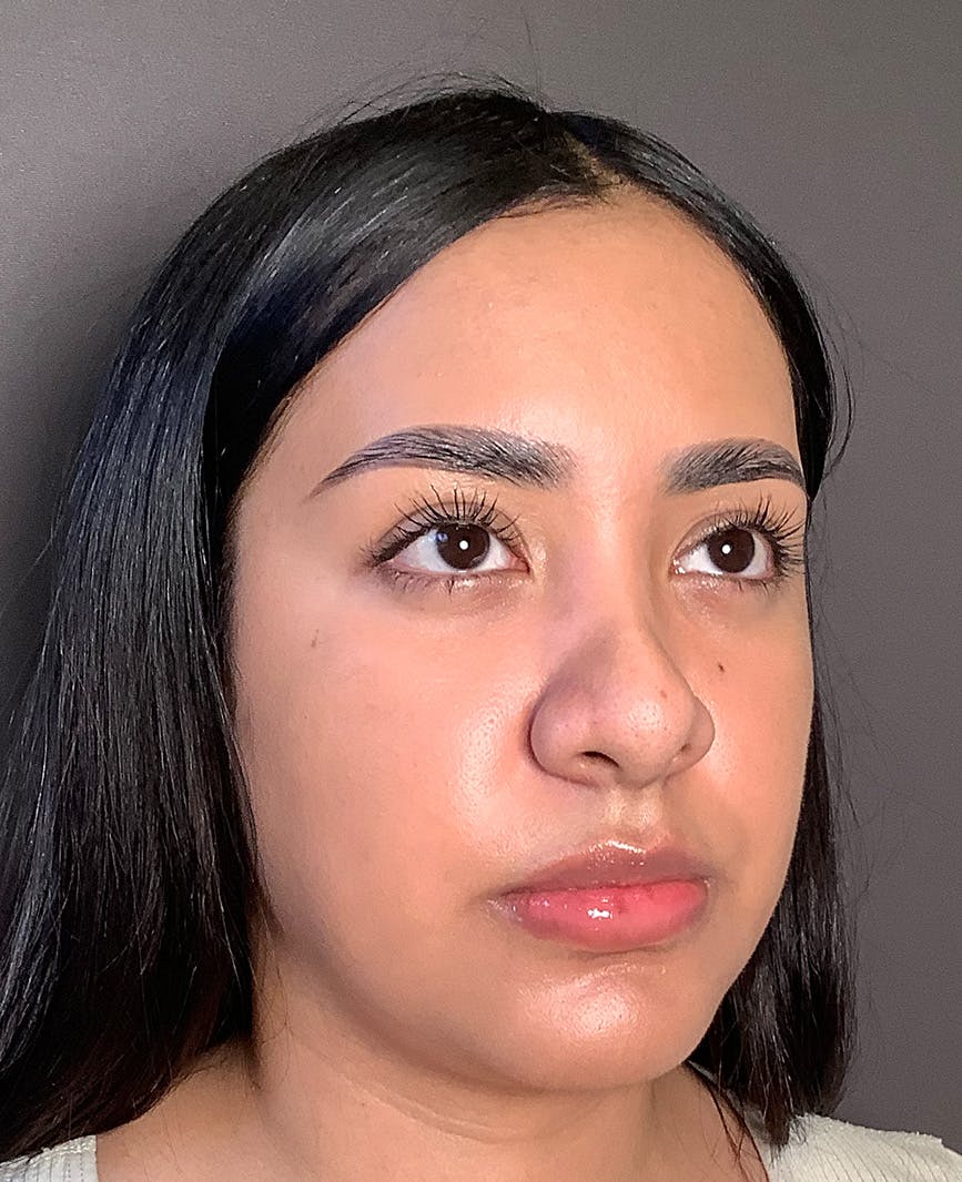 Revision Rhinoplasty Before & After Gallery - Patient 211946 - Image 5
