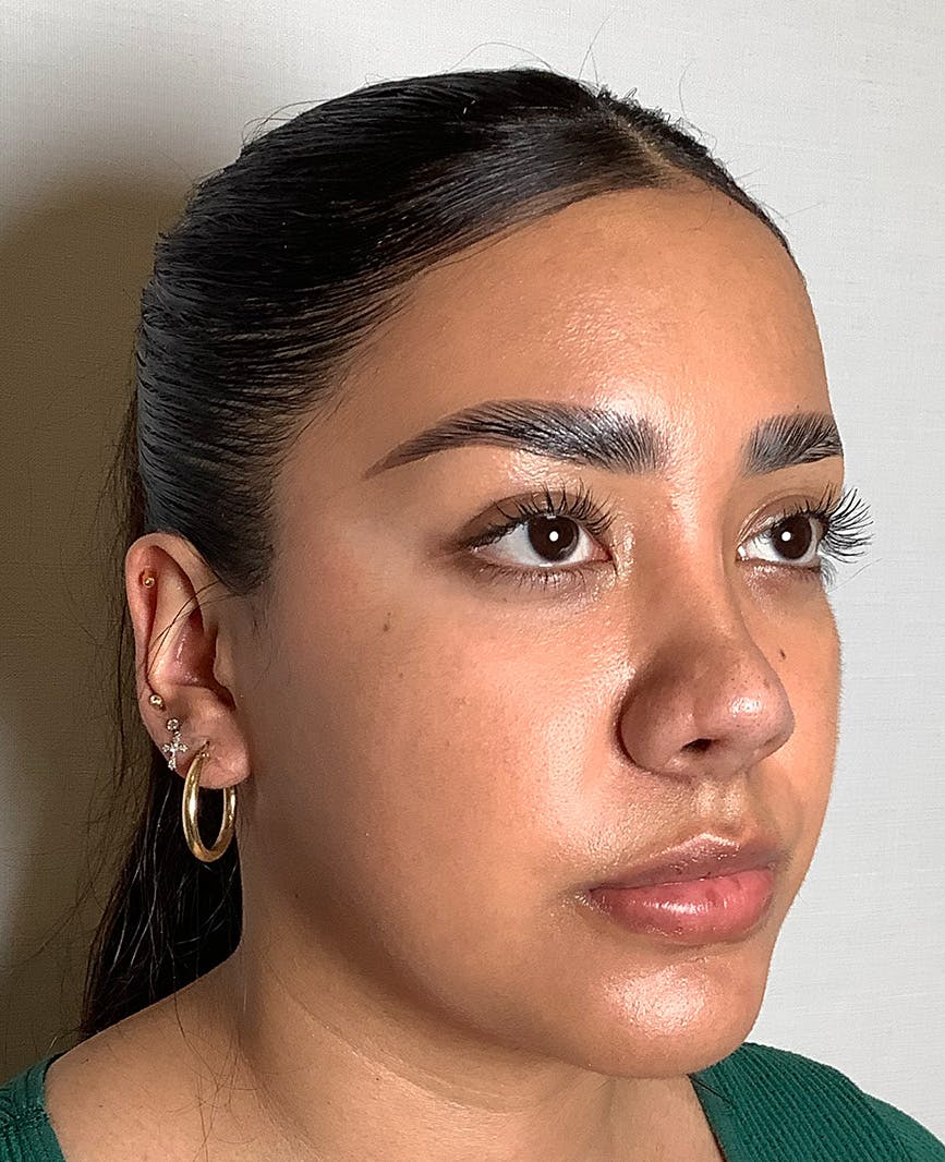 Revision Rhinoplasty Before & After Gallery - Patient 211946 - Image 6