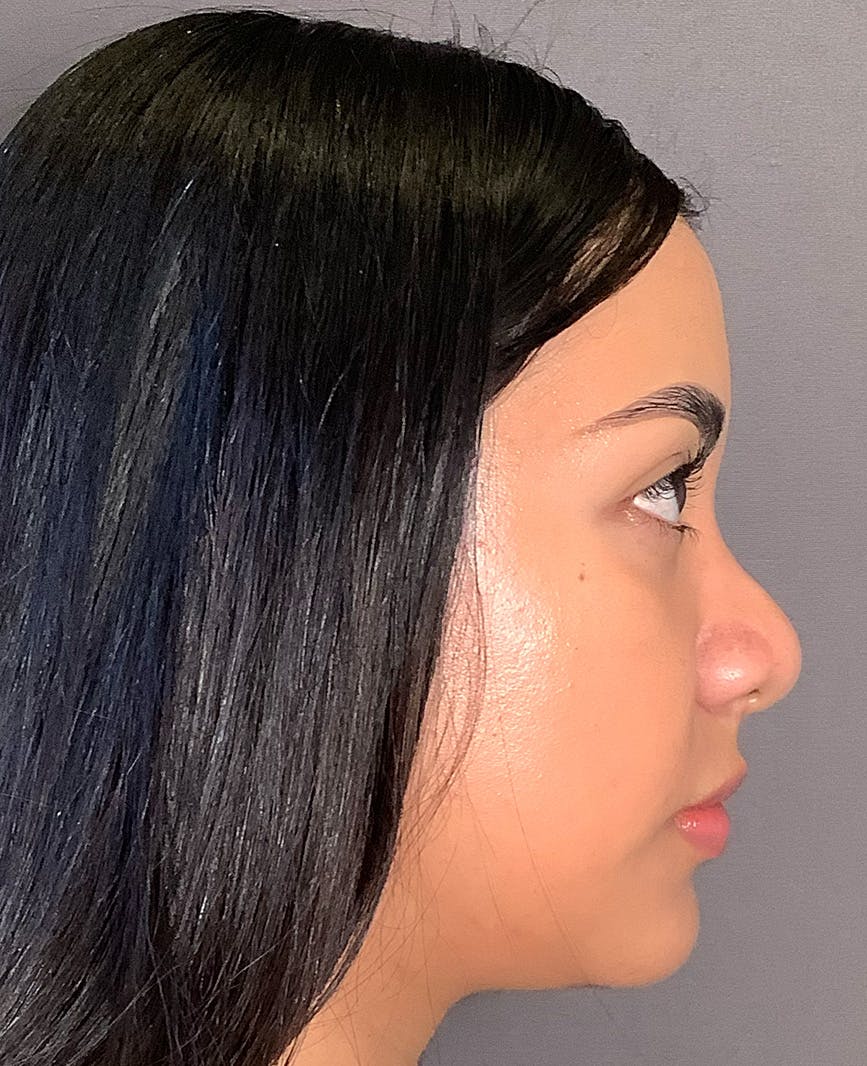 Revision Rhinoplasty Before & After Gallery - Patient 211946 - Image 1